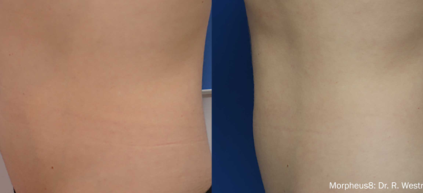 인모드 치료사례05