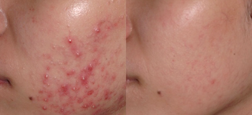 포토나 스타워커 치료사례01