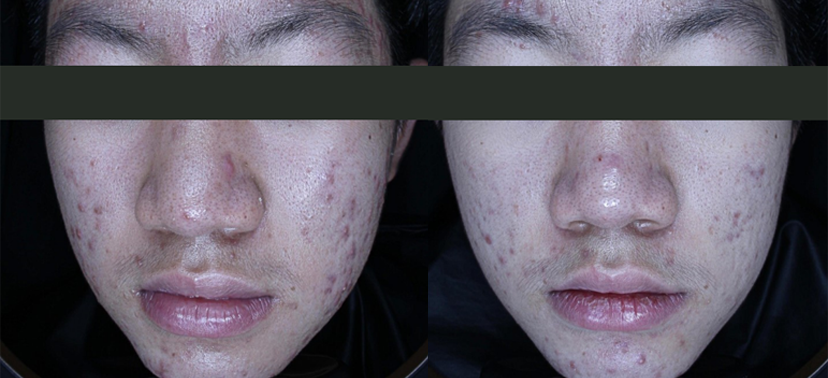 플래티넘PTT 치료사례01